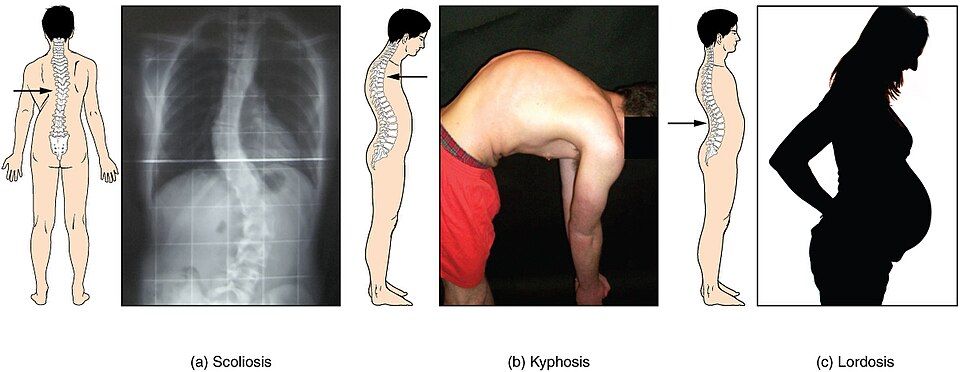 Normal and abnormal curves of the spine