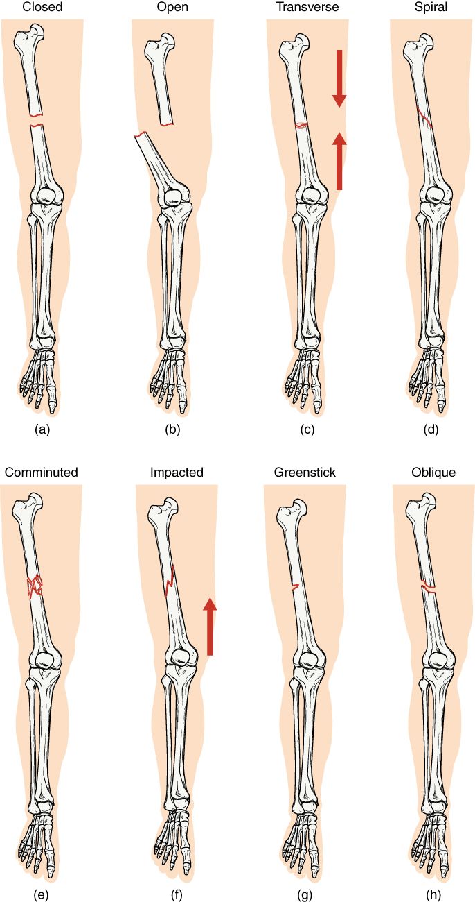Fractures & Bone Repair reference figure