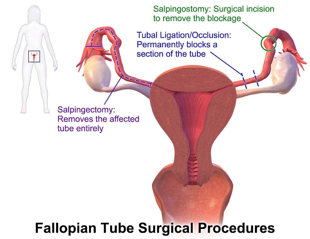 Illustration of fertilisation in the fallopian tube followed by cleavage stages from zygote to morula to blastocyst arriving in the uterus
