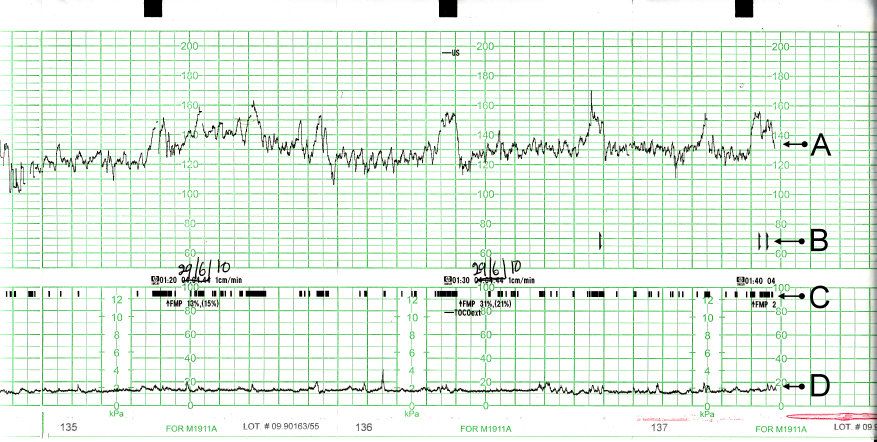 Electronic fetal monitoring produces two synchronised traces &mdash; fetal heart rate above, uterine activity below &mdash; and the relationship between them is the whole interpretation.