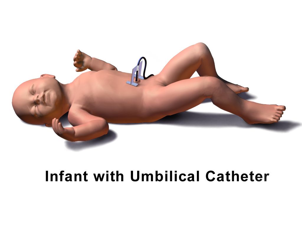 Newborn placed skin-to-skin on the birthing parent's chest immediately after birth with the umbilical cord still attached