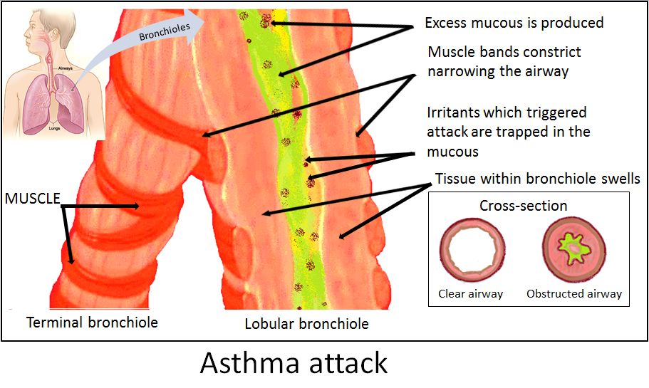 Asthma narrows the airway by three simultaneous mechanisms &mdash; bronchospasm, mucosal oedema and mucus &mdash; which is why one drug class is never enough.