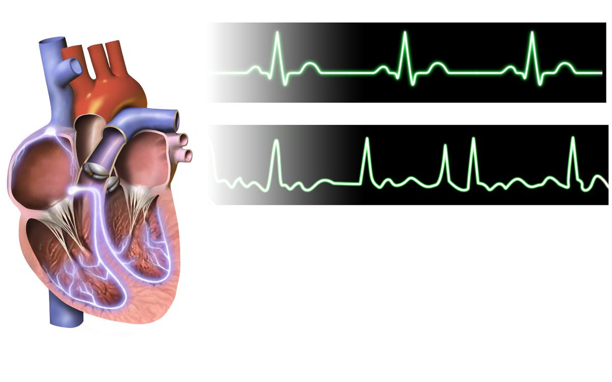 Rhythm strip of atrial fibrillation showing an irregularly irregular ventricular response, absent P waves and a chaotic fibrillatory baseline