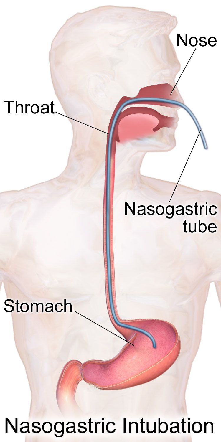 Illustration of a nasogastric tube passing from the nostril through the esophagus into the stomach, with the external portion secured to the nose