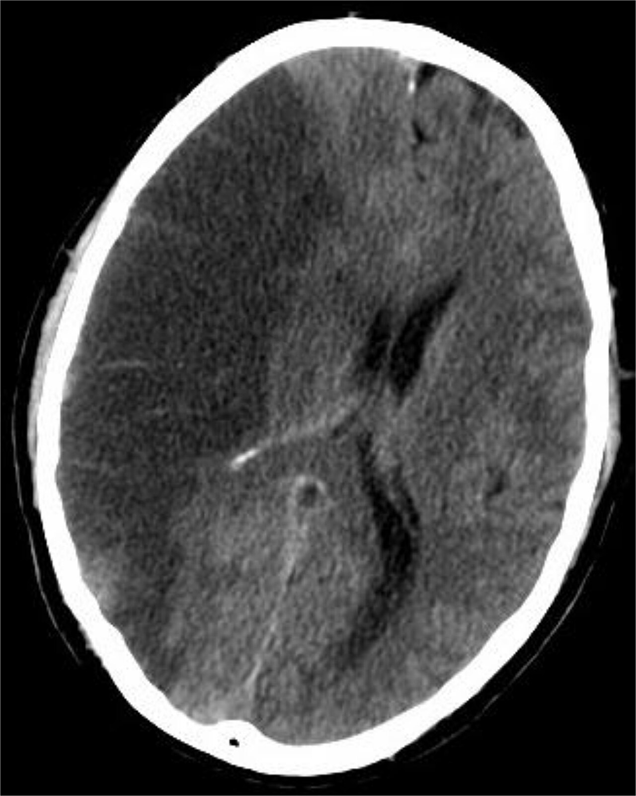 An established middle cerebral artery infarct appears as a hypodense territory on non-contrast CT, but in the first hours the scan is often normal &mdash; its job is to exclude blood, not to confirm i