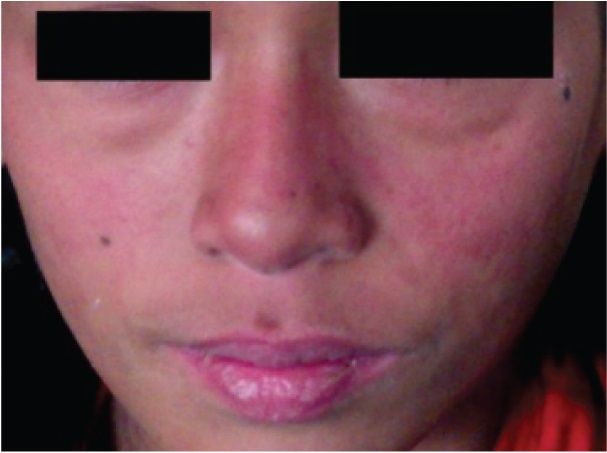 The malar rash of lupus crosses the bridge of the nose and characteristically spares the nasolabial folds.