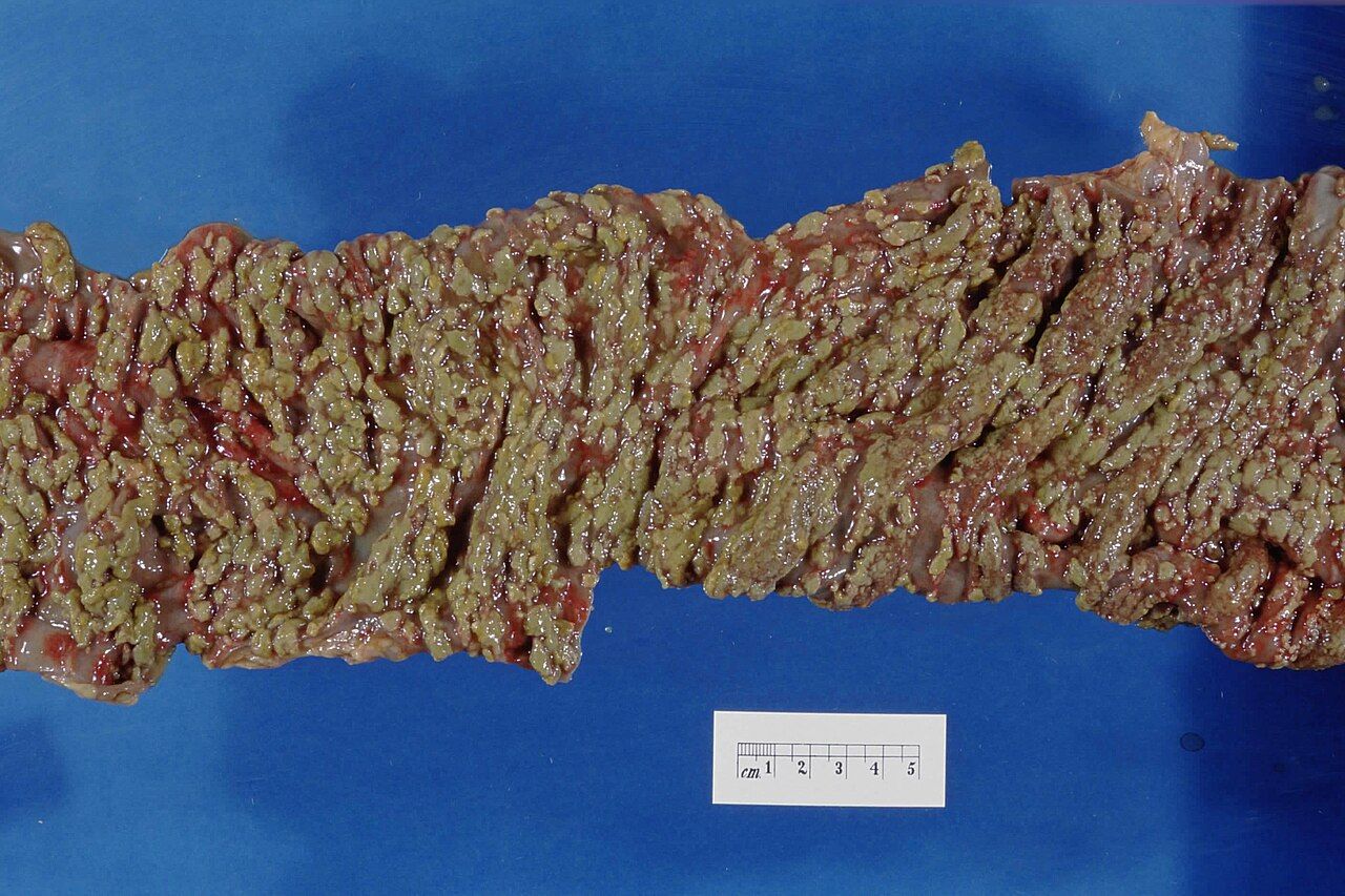 Pseudomembranous colitis: the yellow-white plaques of Clostridioides difficile infection, the commonest and most preventable consequence of unnecessary antibiotics.