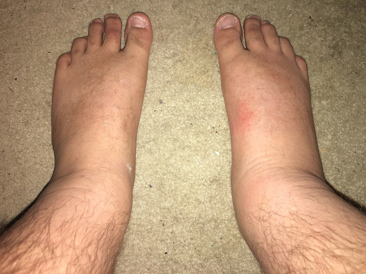Cellulitis of the lower leg: unilateral, warm, tender, poorly demarcated erythema &mdash; marking and dating the border is how you measure response.