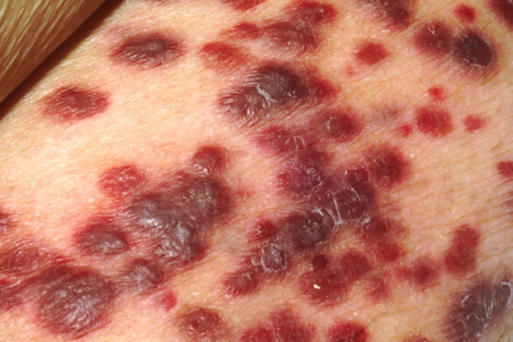 Illustrated chart of primary skin lesions showing macule, papule, plaque, nodule, vesicle, bulla, pustule and wheal in cross-section and surface view