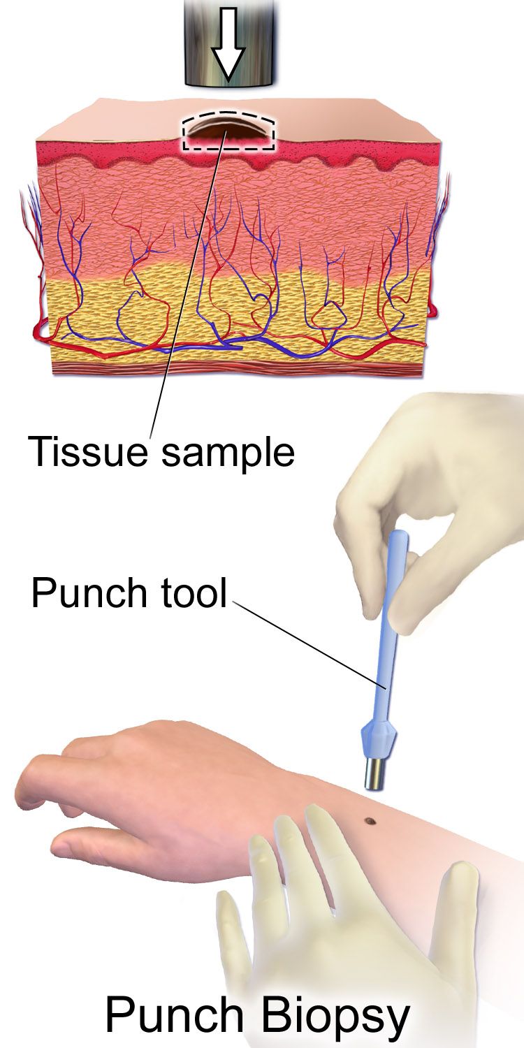 A punch biopsy removes a full-thickness cylinder of skin for microscopic examination. Skin biopsy is the defining diagnostic procedure of dermatology; the punch is one of its common forms, and the shave biopsy is the one performed most often in the outpatient clinic.