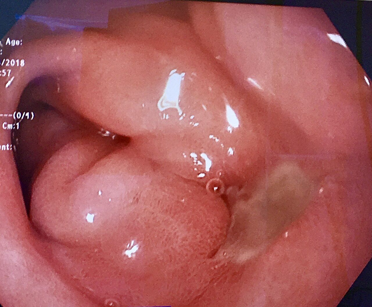 A peptic ulcer eroding the mucosa &mdash; the depth of the defect is what separates an erosion from an ulcer and an ulcer from a perforation.