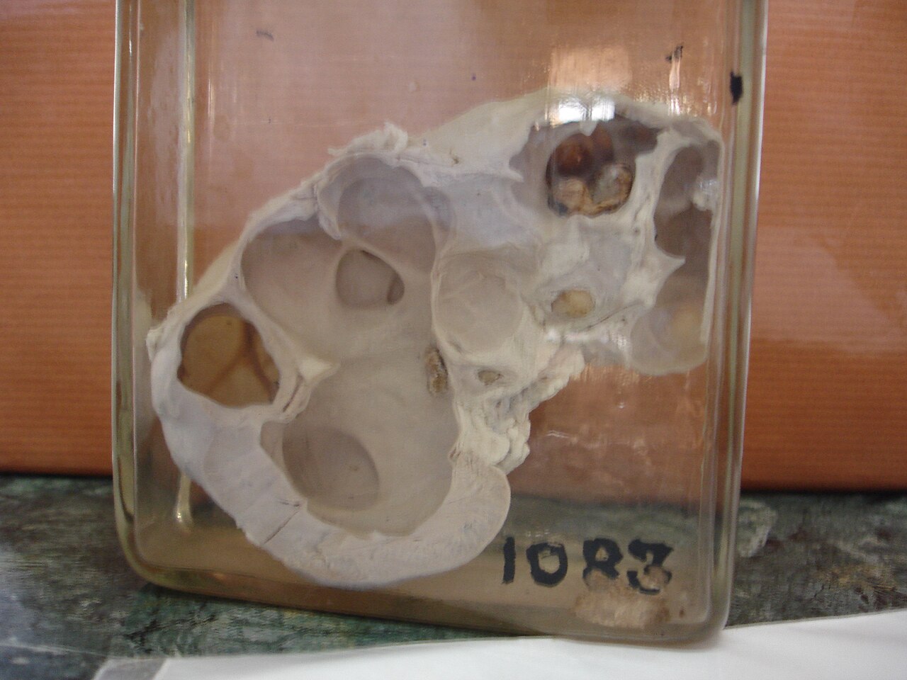 Obstruction backs urine up into the collecting system &mdash; hydr/o + nephr/o + -osis, water in the kidney.