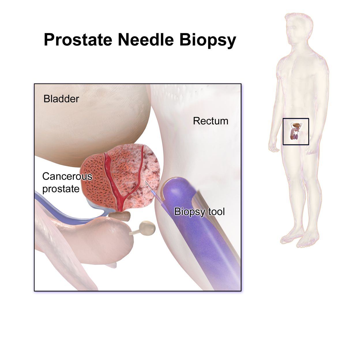 Anatomical comparison of the short female urethra and the longer male urethra passing through the prostate gland, with the bladder above each