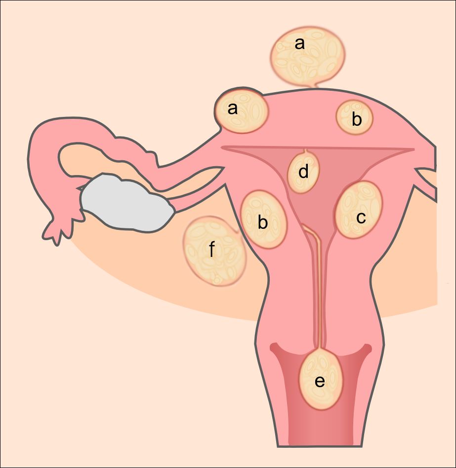 Uterine leiomyomas &mdash; lei/o smooth + my/o muscle + -oma tumor &mdash; classified by where in the wall they sit.
