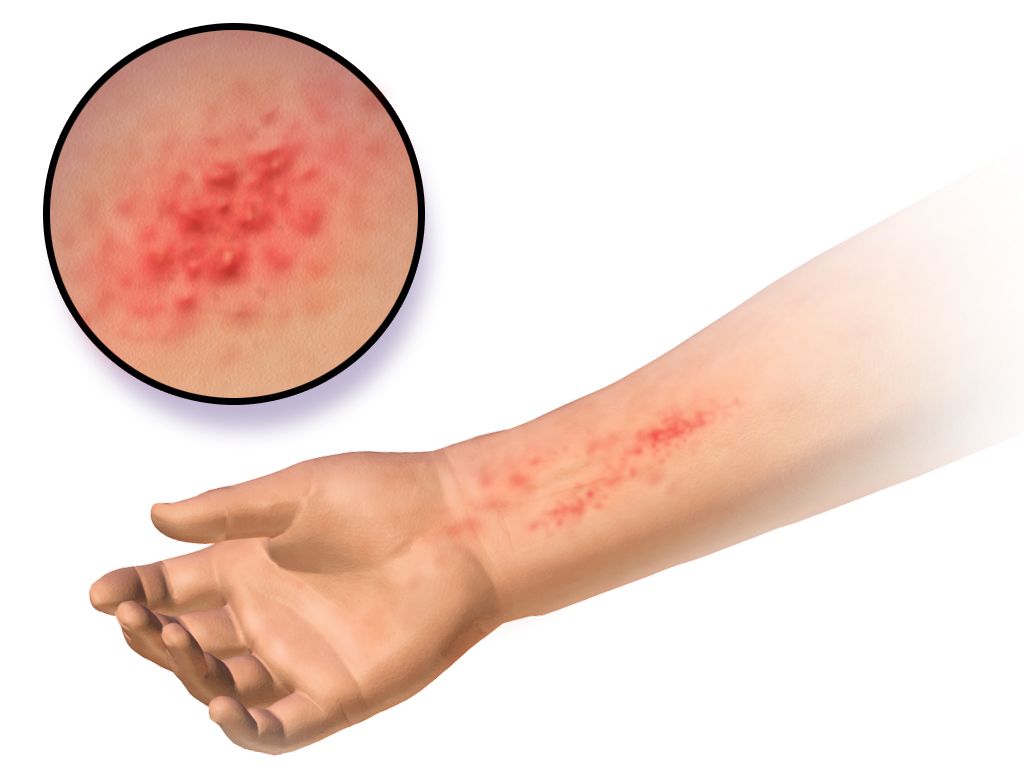 Close-up of reddened, dry, cracked hands showing irritant dermatitis from repeated washing