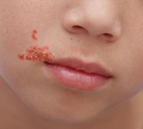 Impetigo lesions with the characteristic honey-colored crust on the skin