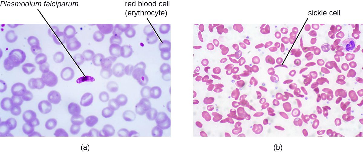 Bacteria in a sample of blood, illustrating bloodstream infection