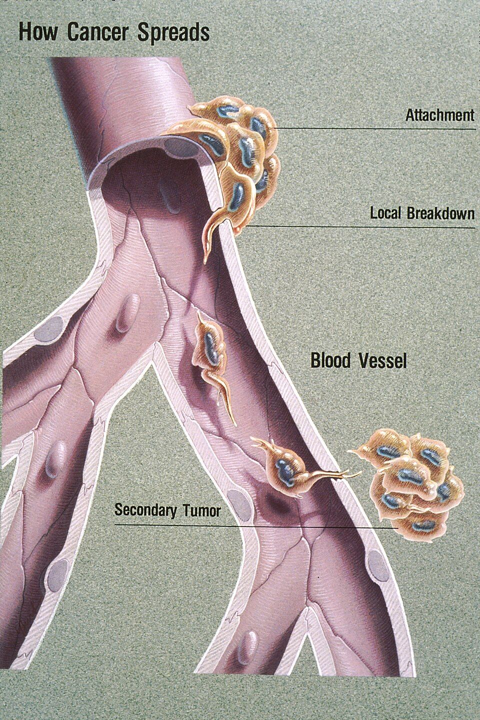 Growth & metastasis reference figure