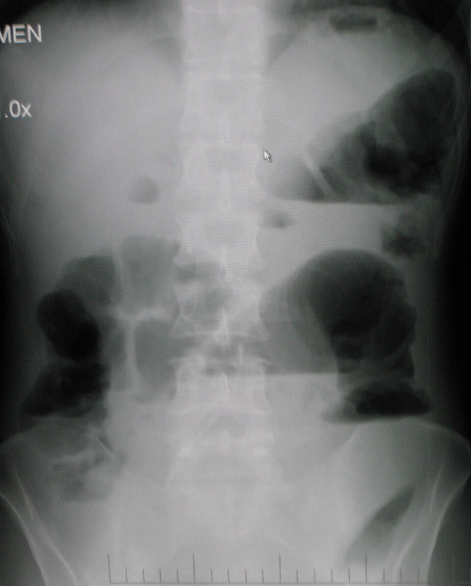 Reference figure for bowel obstruction and GI bleeding