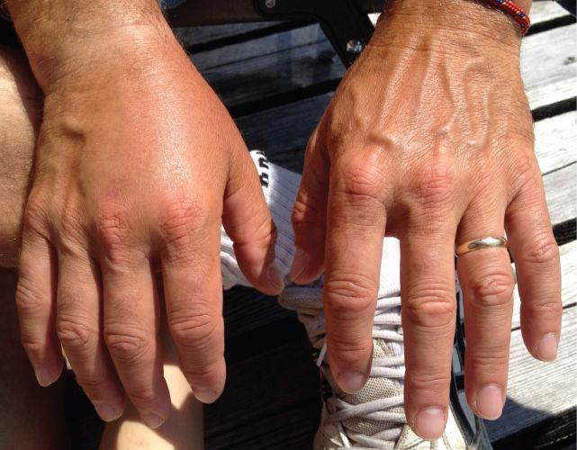 Reference figure: how edema forms