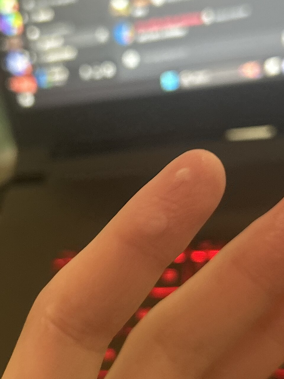 Reference figure on burns