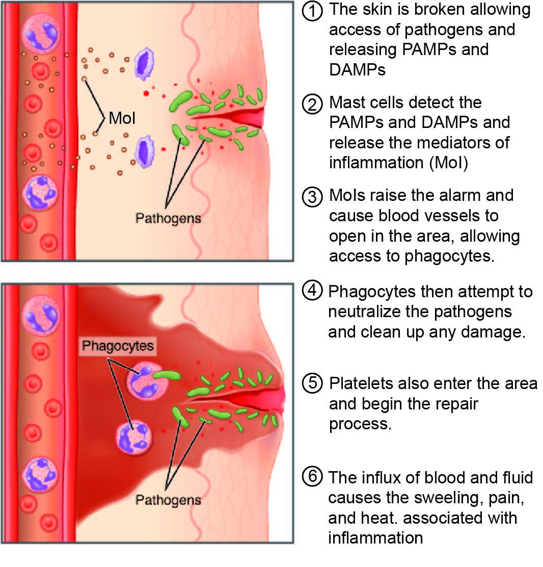 The inflammatory process reference figure showing vasodilation, edema, and immune cell recruitment